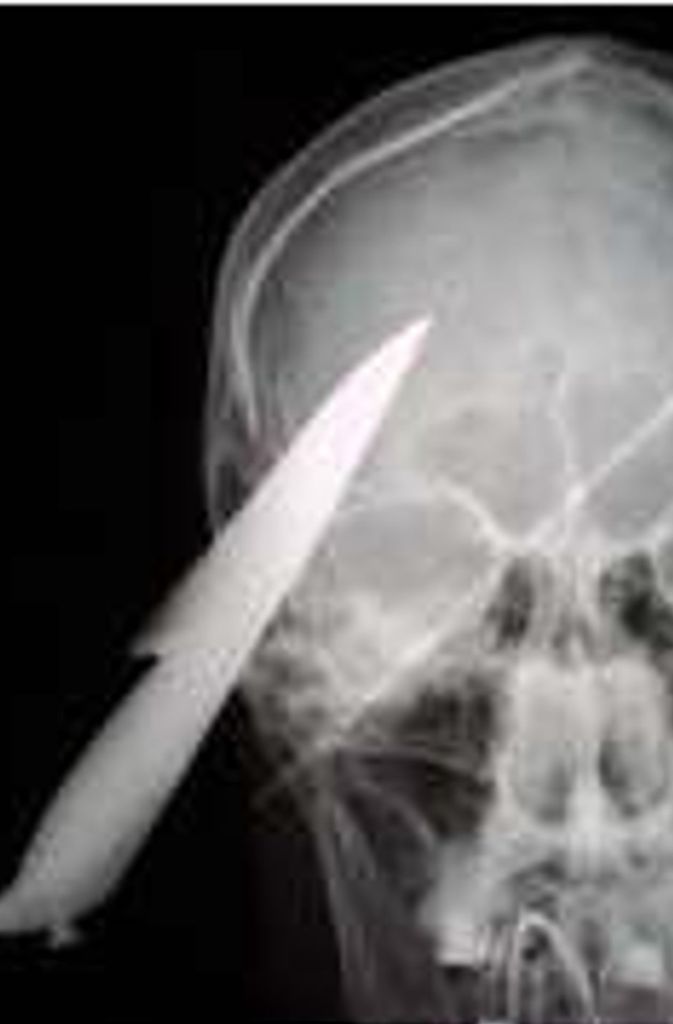 Bei diesem 30-jährigen Patienten steckt ein Messer oberhalb des rechten Auges im Schädel.