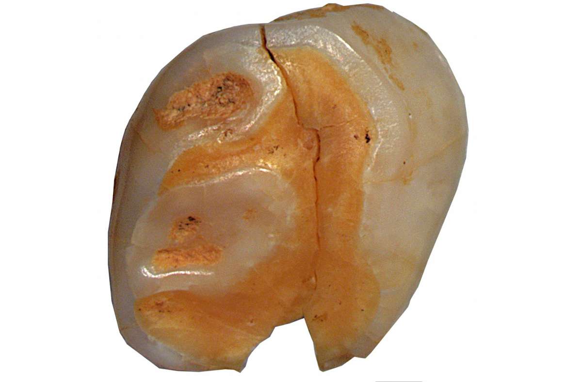 Vermutlich beim Zahnwechsel verlor ein Neandertaler-Kind vor 40 000 bis 70 000 Jahren diesen Milchzahn. Foto: ERC project Success, University of Bologna, Italy/www.uni-frankfurt.de/93639226