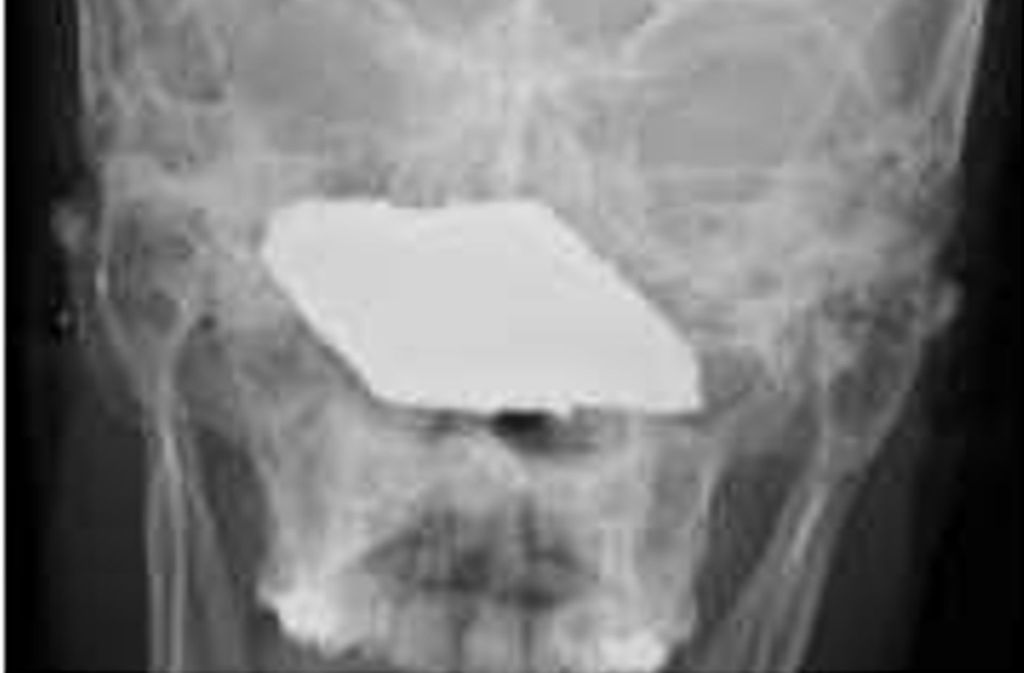 Metallsplitter: Das Röntgenbild zeigt den Schädel eines 22-Jährigen. Mitten in seinem Gesicht steckt ein acht mal vier Zentimeter großer Granatsplitter.