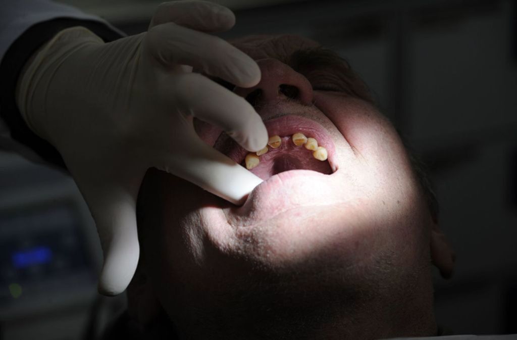 Stellt sich heraus, dass die Schmerzen auf Karies zurückzuführen sind, wird sie mit einem Bohrer beseitigt. Verursacht ein Mikroriss die heftigen Schmerzen, braucht es eine Wurzelbehandlung. „Im Fall einer Zahnfraktur muss eventuell auch ein Zahn gezogen werden“, erläutert Dentist Wolf.