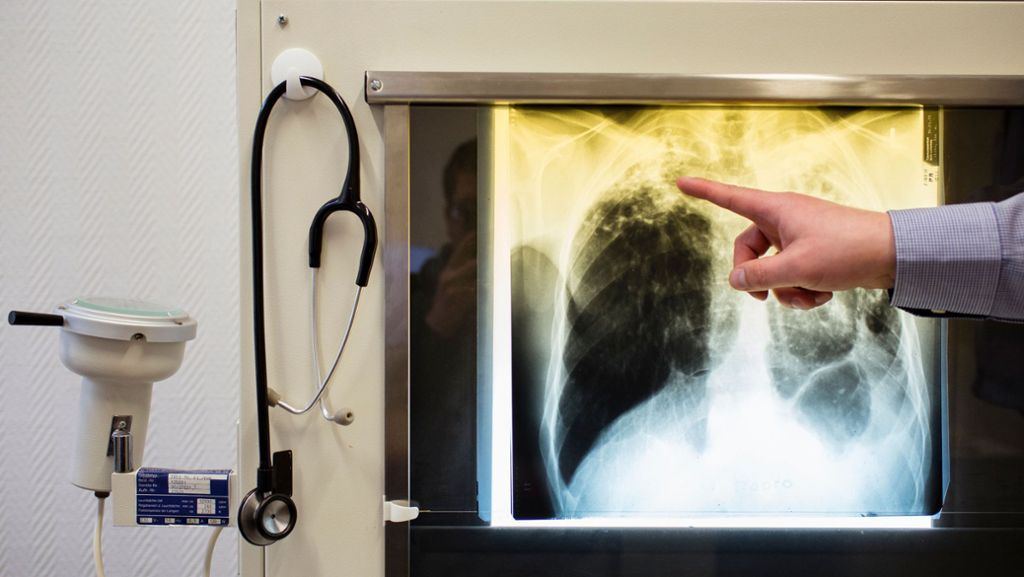 Tuberkulose im Kreis Karlsruhe: Gesundheitsamt rechnet mit mehr Erkrankten