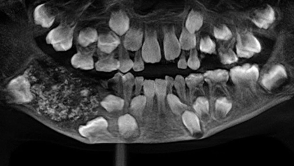 Indien: 526 Zähne im Mund eines Siebenjährigen gefunden