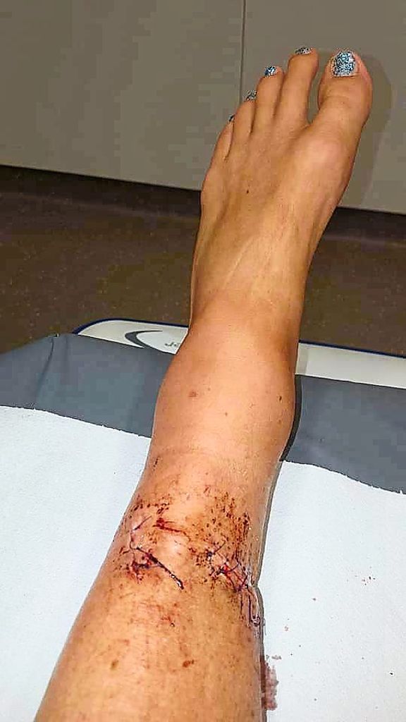 Diese Wunde am Bein hat die Halterin des Kangals bei dem Vorfall erlitten.