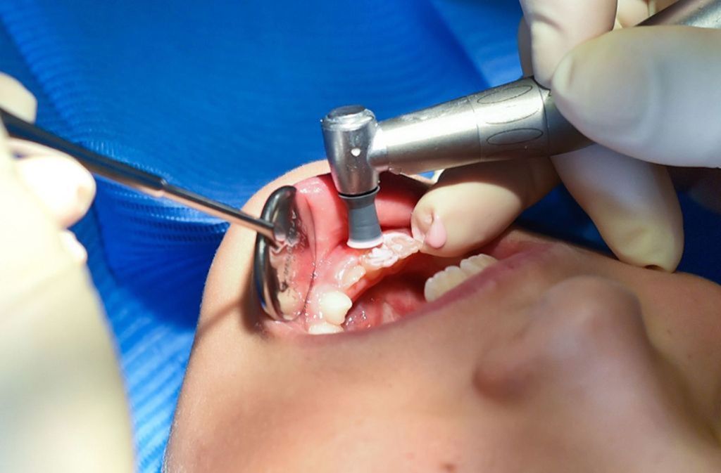 Nicht immer haben Zahnweh-Geplagte die Möglichkeit, sofort einen Zahnarzt aufzusuchen. „In akuten Fällen können Schmerzmittel als Erste-Hilfe-Maßnahme helfen“, sagt Ursula Sellerberg, Sprecherin der Bundesvereinigung Deutscher Apothekerverbände (ABDA).