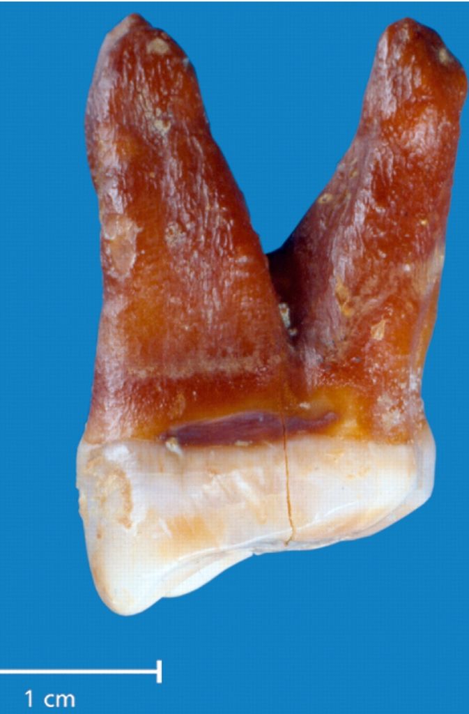 Zahnpflege: Schon der Neandertaler nutzte Zahnstocher, Rillen in den Zähnen deuten auf intensive Mundhygiene des Urmenschen hin.