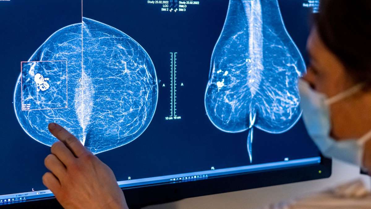 Gesundheit: Brustkrebs-Früherkennung künftig bis 75 Jahre