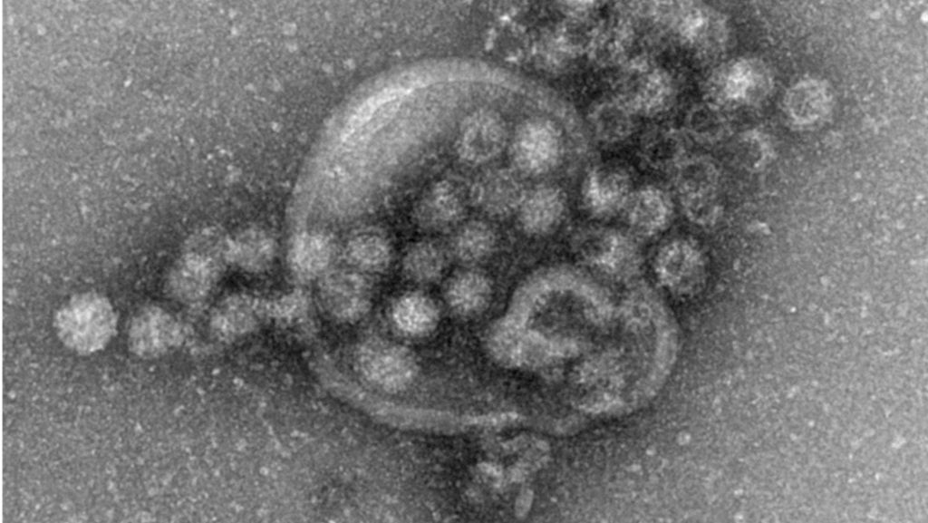 Norovirus in Grundschule: 40 Kinder in Herrenberg erkrankt
