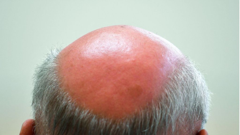 Gravierende Nebenwirkungen: Kläger will Schmerzensgeld nach Haarwuchsmittel-Einnahme
